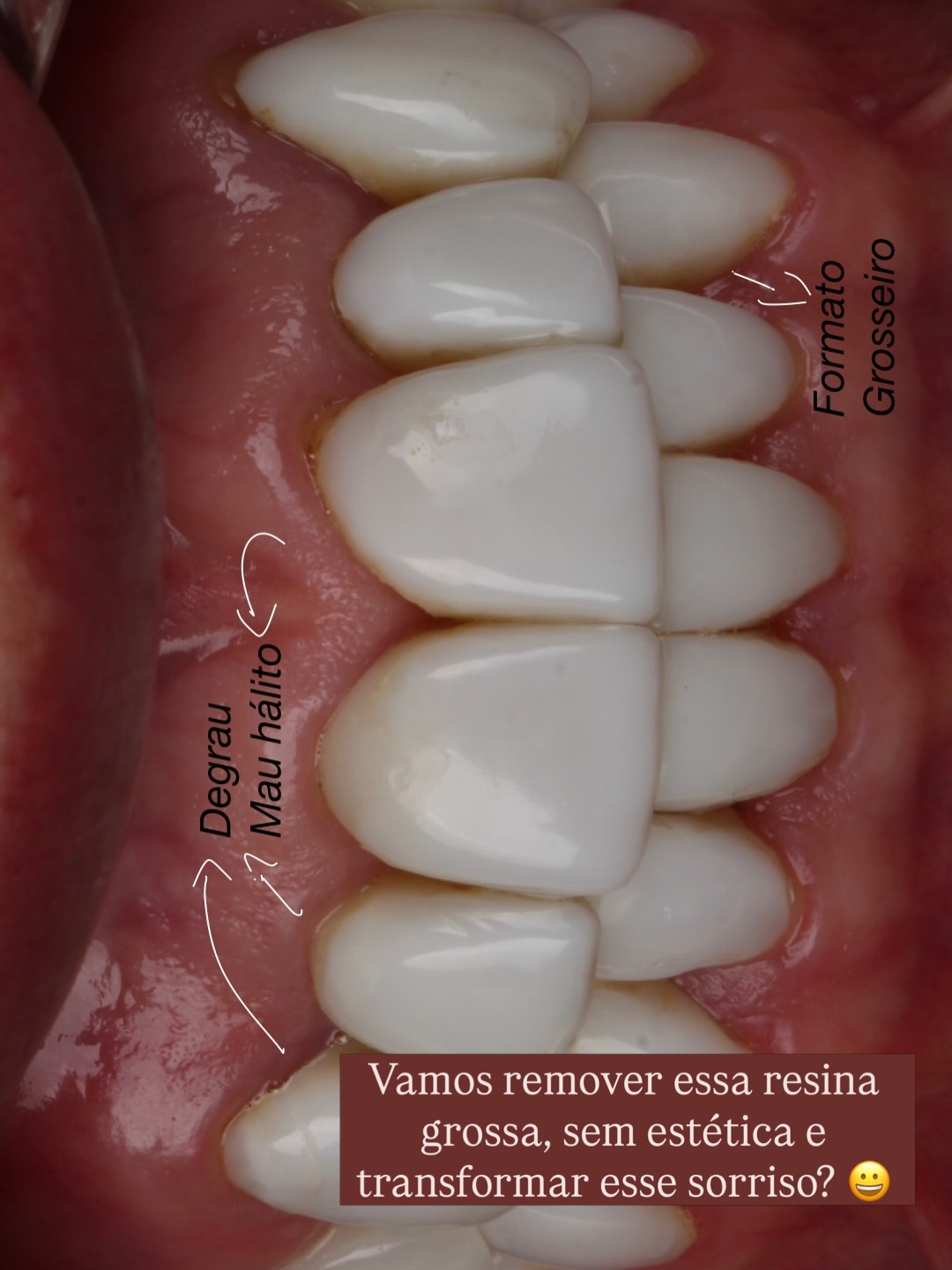 Remoção de resina antiga