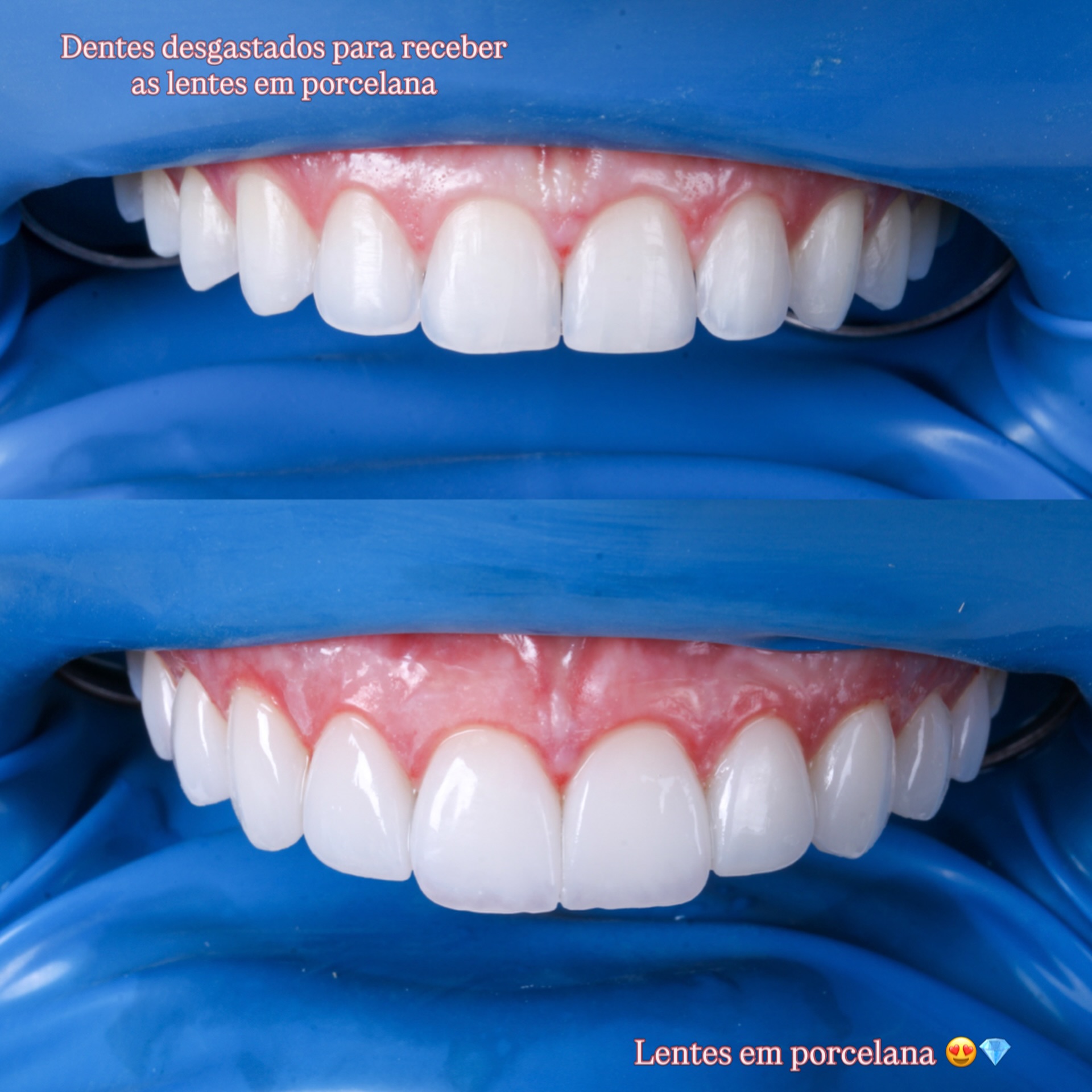 Lentes em porcelana