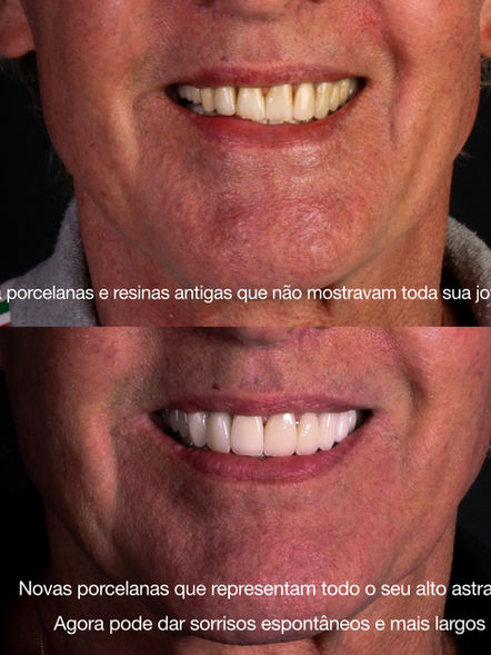 Reabilitação com porcelanas